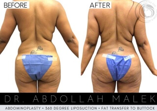 Tummy Tuck #3060 Marge Image