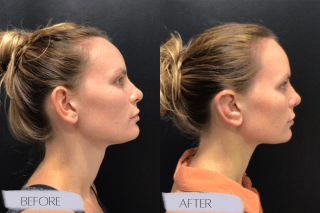 Otoplasty #6947 Marge Image