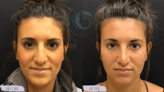 Rhinoplasty #4923 Marge Image