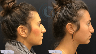 Rhinoplasty #4923 Marge Image