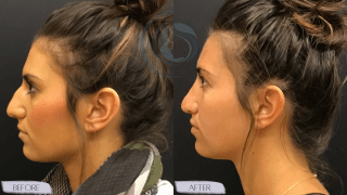 Rhinoplasty #4923 Marge Image