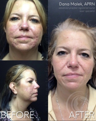 Laser Treatment #4681 Marge Image