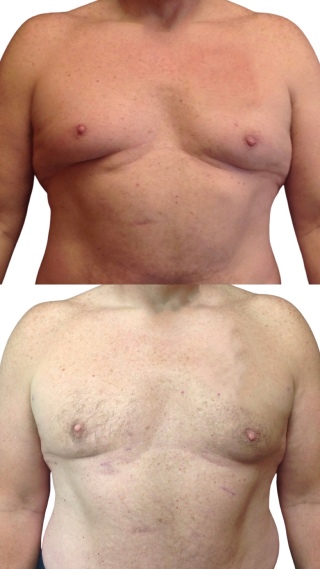 Male Breast Reduction #9318 Marge Image