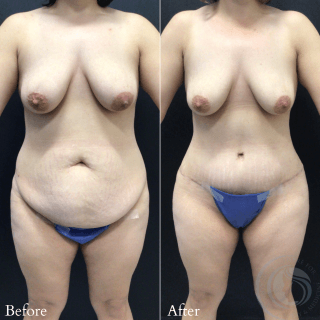 Tummy Tuck #9645 Marge Image