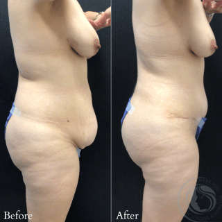Tummy Tuck #9645 Marge Image