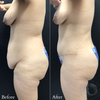 Tummy Tuck #9645 Marge Image