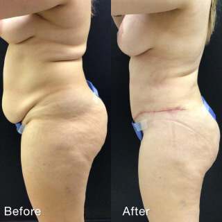 Mommy Makeover #7932 Marge Image