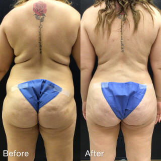 Mommy Makeover #7932 Marge Image