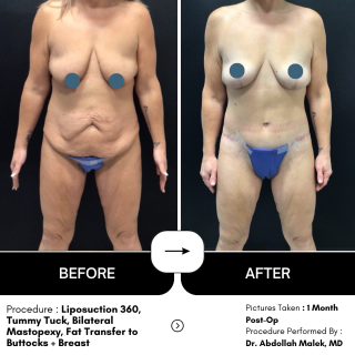 Tummy Tuck #4470 Marge Image