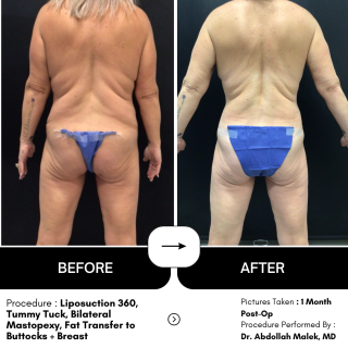 Tummy Tuck #4470 Marge Image