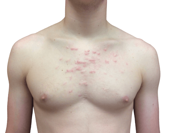 Laser Treatment #3503 Before Image