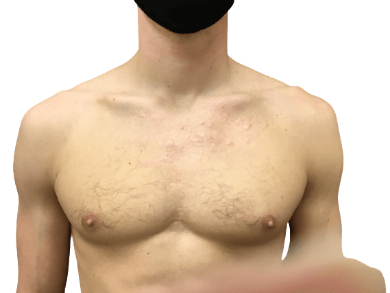 Laser Treatment #3503 After Image