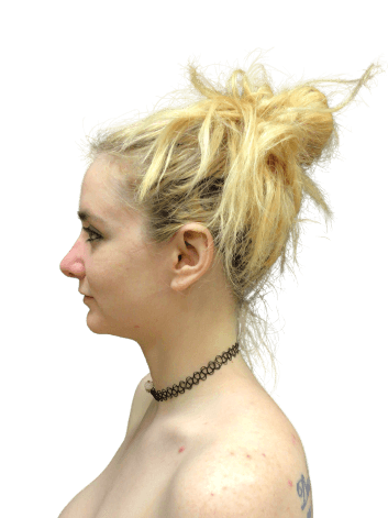 Rhinoplasty #6038 After Image