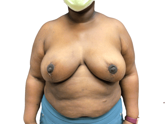 Breast Lift #1009 After Image