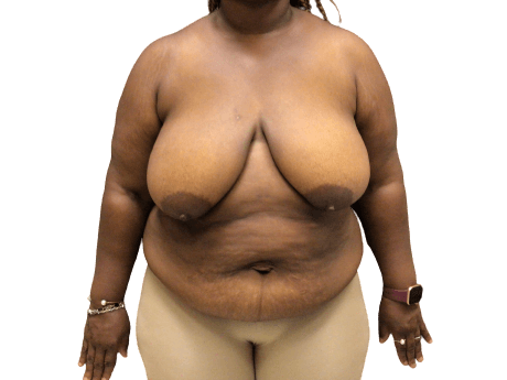 Breast Lift #1009 Before Image