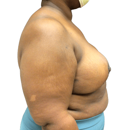 Breast Lift #1009 After Image