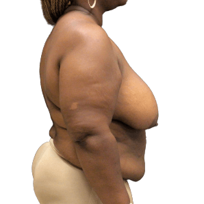 Breast Lift #1009 Before Image