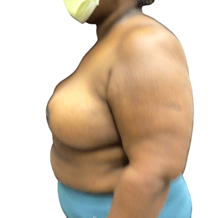 Breast Lift #1009 After Image