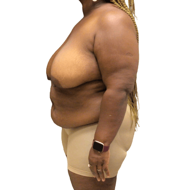 Breast Lift #1009 Before Image