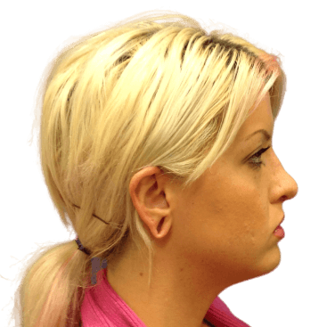 Rhinoplasty #1949 After Image