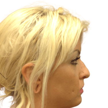 Rhinoplasty #1949 Before Image