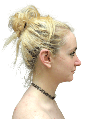 Rhinoplasty #6038 After Image