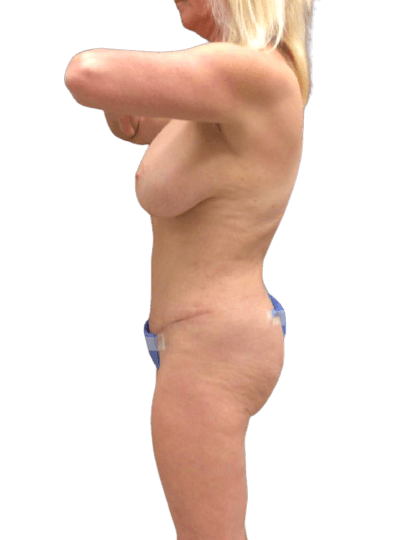 Tummy Tuck #7537 After Image