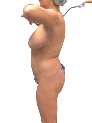 Tummy Tuck #7537 Before Image