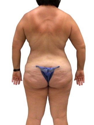 Tummy Tuck #6107 After Image