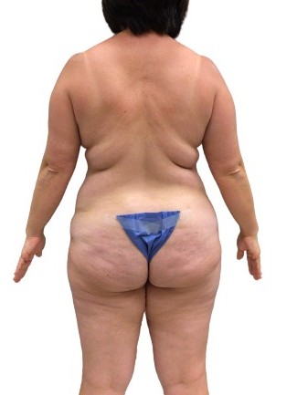 Tummy Tuck #6107 Before Image
