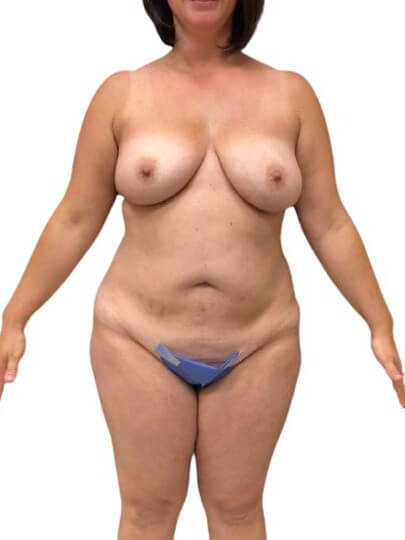 Tummy Tuck #6107 Before Image