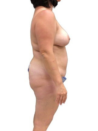 Tummy Tuck #6107 Before Image