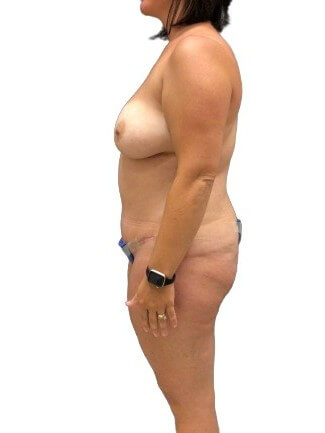 Tummy Tuck #6107 After Image