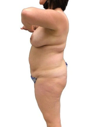 Tummy Tuck #6107 Before Image